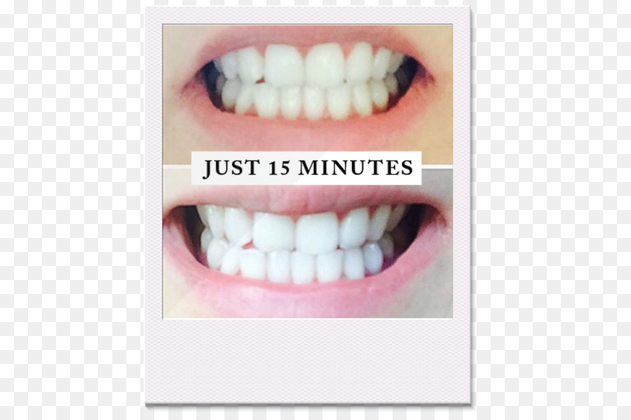 Diş Beyazlatma，Insan Diş PNG