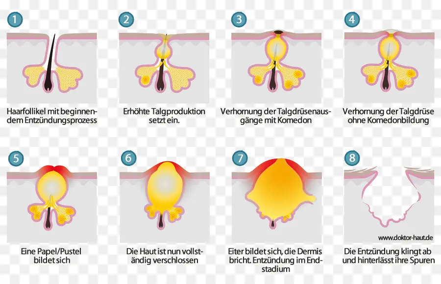 Sivilce Oluşumu Diyagramı，Deri PNG