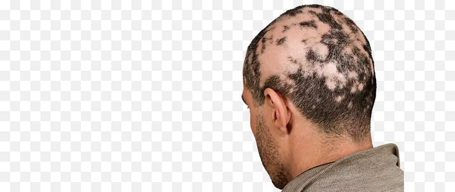 Alopesi，Saç Dökülmesi PNG