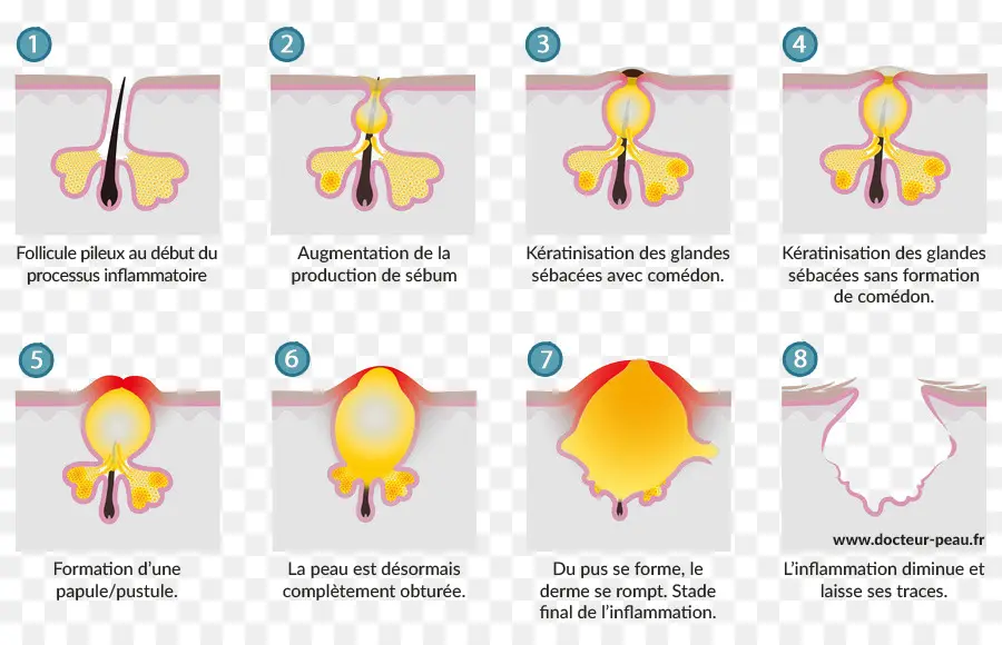 Sivilce Oluşumu Diyagramı，Deri PNG