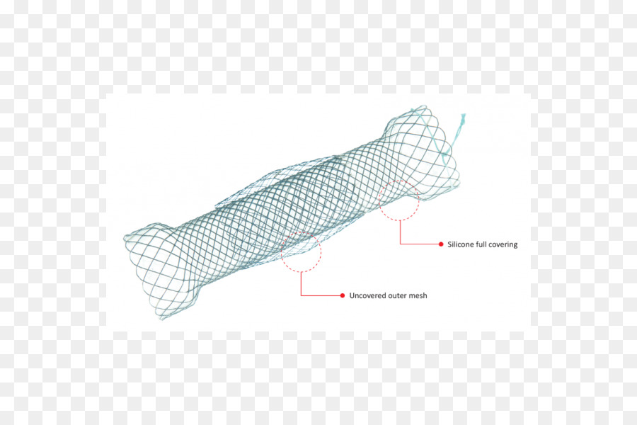 Stent，Yemek Borusu Varisleri PNG