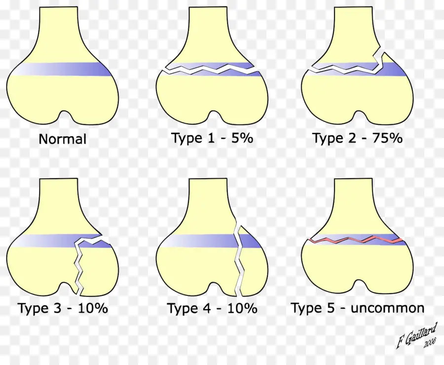 Salter Harris Kırılma Tipleri，Kırık PNG