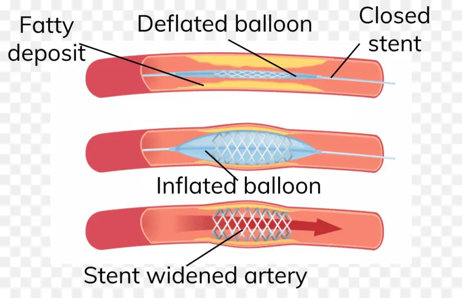 Stent Prosedürü，Arter PNG