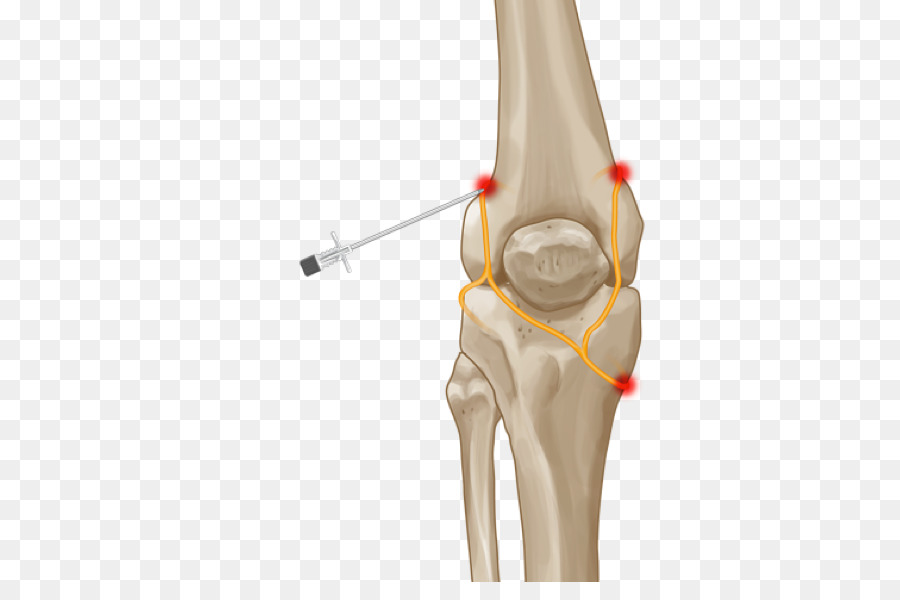 Diz Cerrahisi İllüstrasyonu，Diz PNG