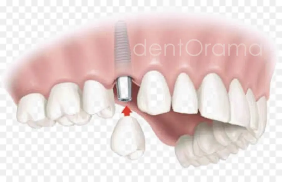 Diş Implantı，Diş PNG