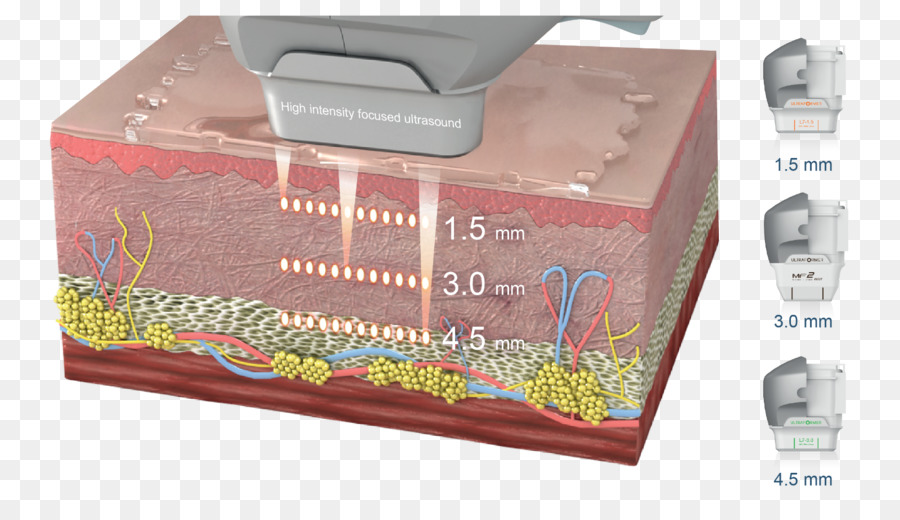 Highintensity Ultrason Odaklı，Yara Izi Azaltma PNG