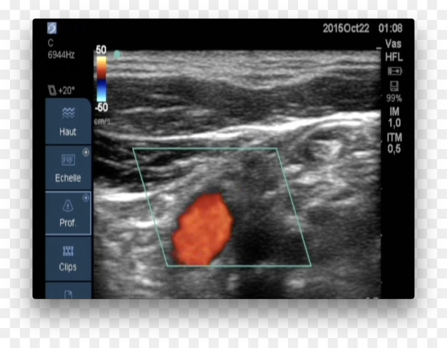 Tıbbi Görüntüleme，Karotis Ultrasonografi PNG