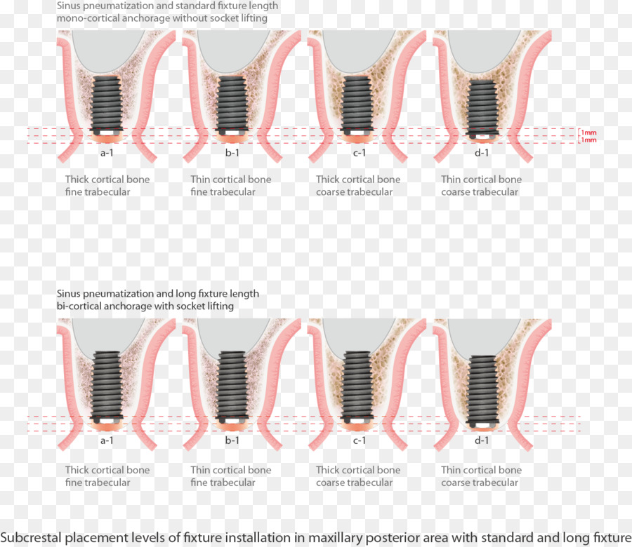 Diş Implantı，Maksiller Sinüs PNG
