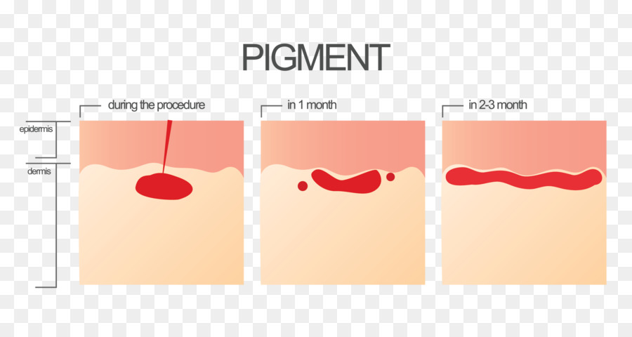 Cilt Pigmentasyonu，Prosedür PNG