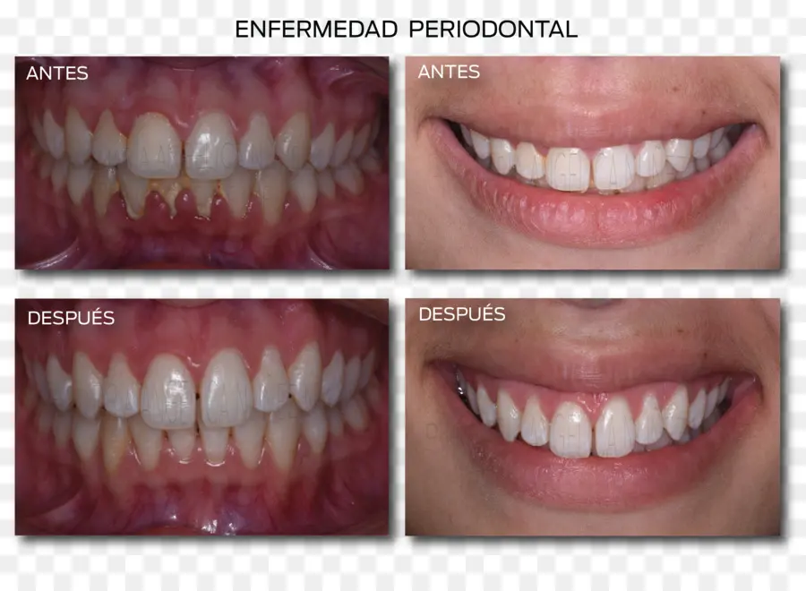 Periodontal Hastalık，Dişler PNG