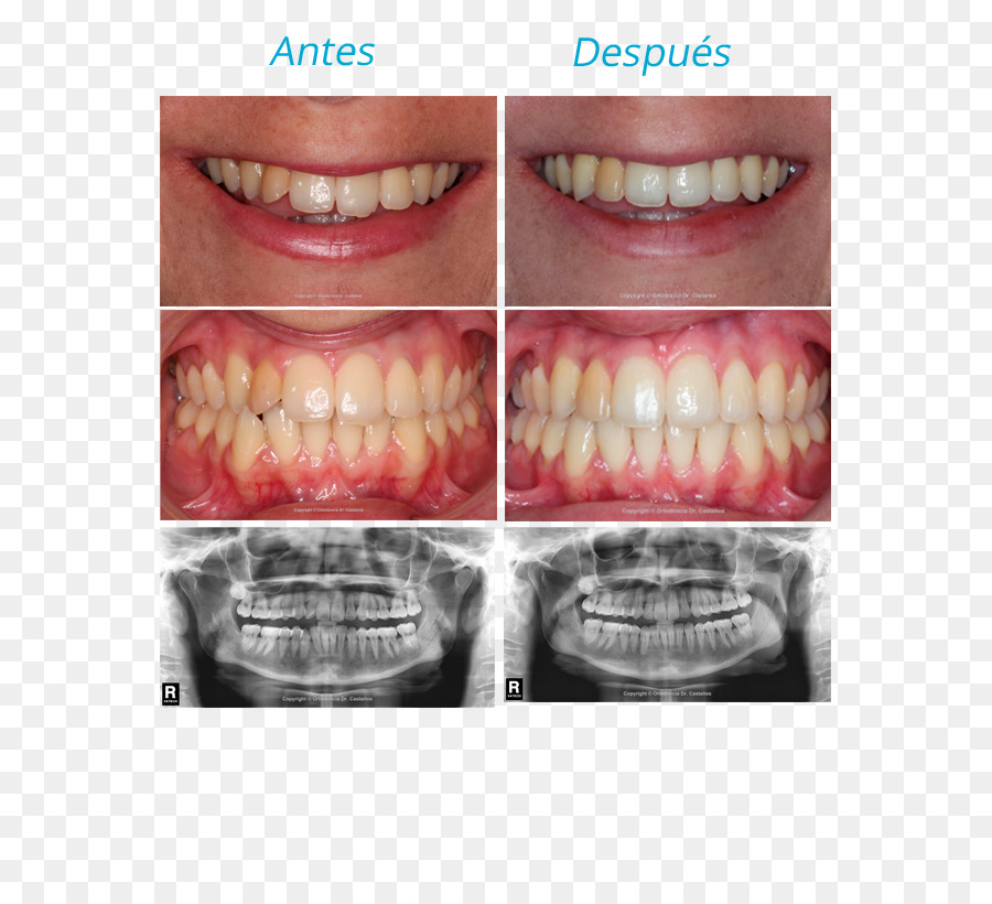 Diş，Ortodonti PNG